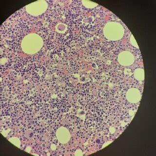 Bone marrow trephine biopsy showing hypercellular BM with trilineage ...