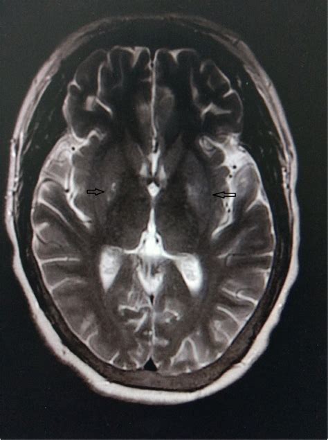 Syndrome of uremic encephalopathy and bilateral basal ganglia lesions in non-diabetic ...