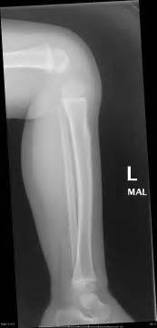 Tibial torus fracture | Image | Radiopaedia.org