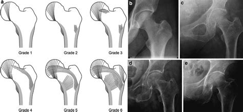 Osteoporosis X Ray Vs Normal