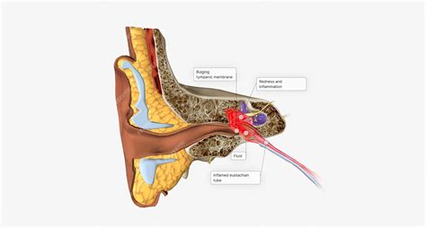 Premium Photo | Acute otitis media is an infection and inflammation of the middle ear usually ...