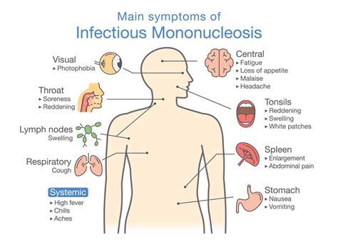 Infectious Mononucleosis : Overview, Causes, Symptoms, Treatment - illness.com