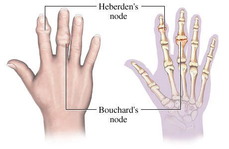 OA Can Cause Bone Spurs: Heberden’s Node- DIP, Bouchard's Node- PIP | Rheumatoid arthritis ...