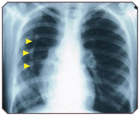 Pulmonary Hypoplasia | Obgyn Key