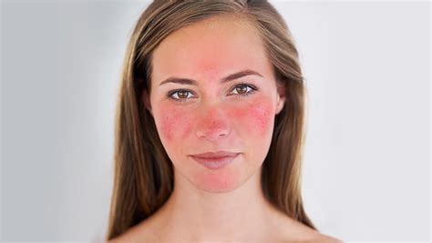 What You Can Do About Red, Sensitive Or Inflamed Skin