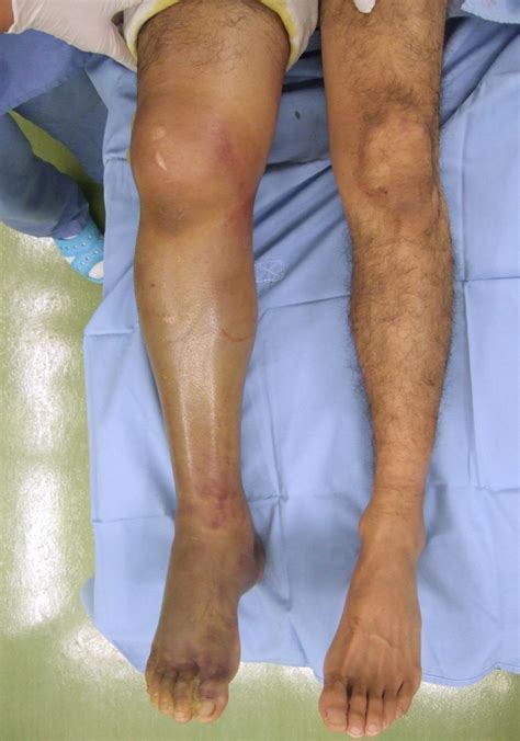 Two cases of unidentified acute compartment syndrome | BMJ Case Reports