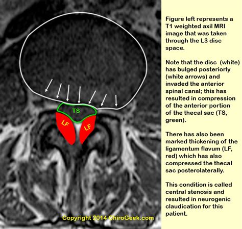 Thecal Sac Mri Anatomy Store Deals | www.bharatagritech.com