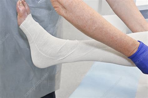 Dressing leg ulcer - Stock Image - C050/6885 - Science Photo Library