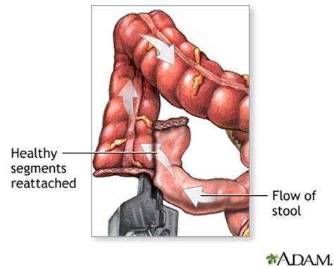 Large bowel resection - series | In-Depth Reports | St. Luke's Hospital