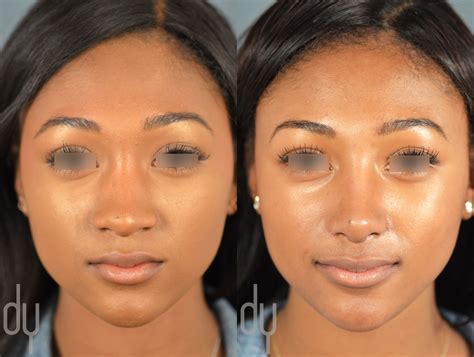 Beverly Hills Rhinoplasty Specialist Dr. Donald Yoo performed a primary ...