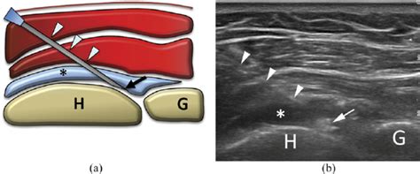 (a) Scheme and (b) ultrasound image of glenohumeral intra-articular ...