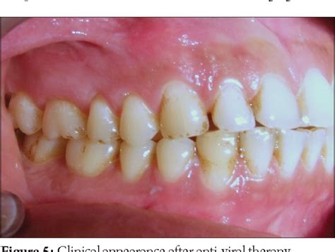 Secondary Herpetic Gingivostomatitis