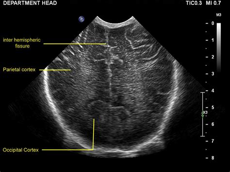 Practical guide to neonatal cranial ultrasound (CrUS): basics - Paediatrics and Child Health