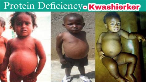 What is Kwashiorkor? Causes, Sign & Symptoms, Treatment? — GS India ...