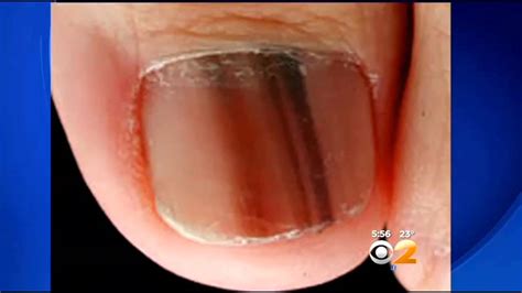 Nail Melanoma Symptoms - Nail Ftempo