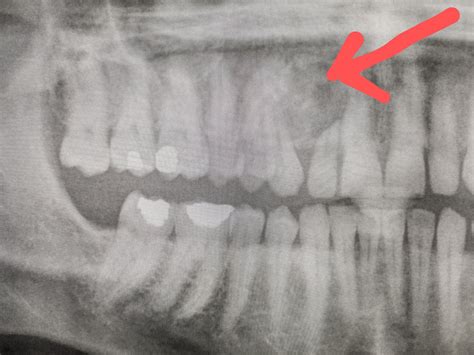 Botryoid Odontogenic Cyst