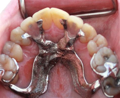 Partial Dentures (plates)