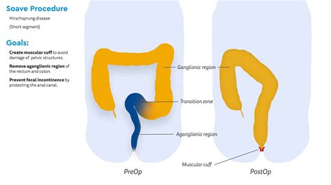 The Soave Procedure (Transanal approach) for Rectosigmoid Hirschsprung Disease on Vimeo