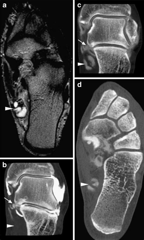 Tarsal Tunnel Syndrome Mri - Captions Beautiful