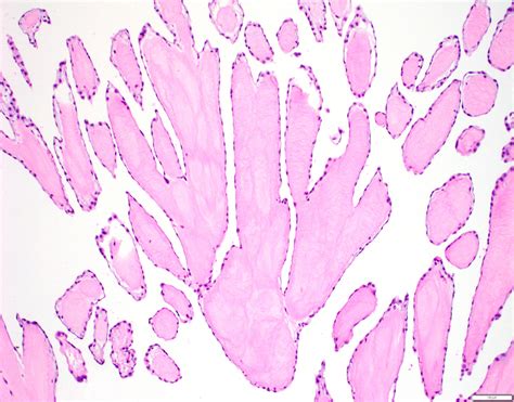 Pathology Outlines - Papillary fibroelastoma