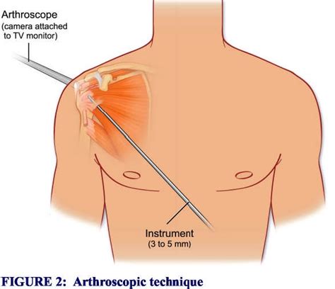 SLAP Tear Surgery and Recovery: WHAT IS A SLAP Tear?