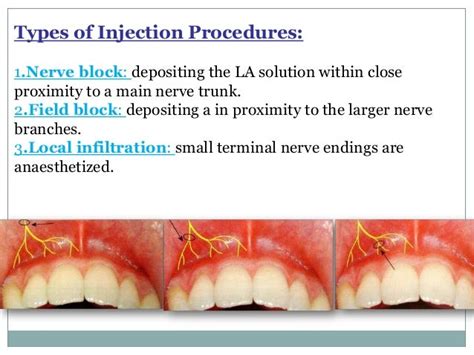 Anesthesia Block Types