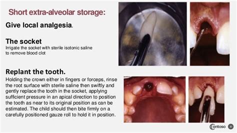 Tooth avulsion dr.maryam salman