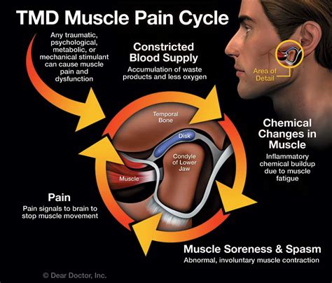 TMJ : Ultimate Guide to Temporomandibular Joint Dysfunction & Treatment