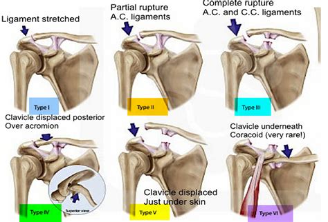 Separated Shoulder - Causes, Symptoms, Exercises, Treatment