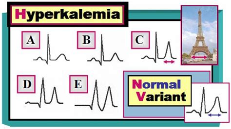 Hyperkalemic EKG Manifestations - APN Toolkit: EBN