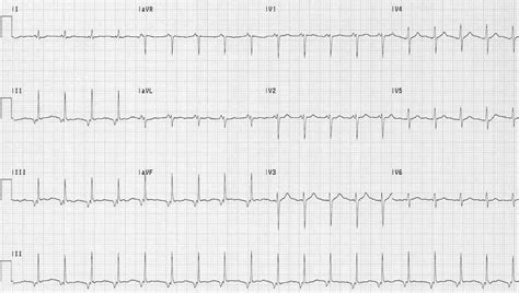 Accelerated Junctional Rhythm (AJR) • LITFL • ECG Library Diagnosis