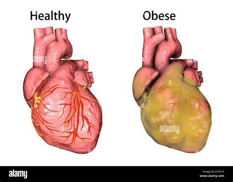 Heart Of An Obese Person