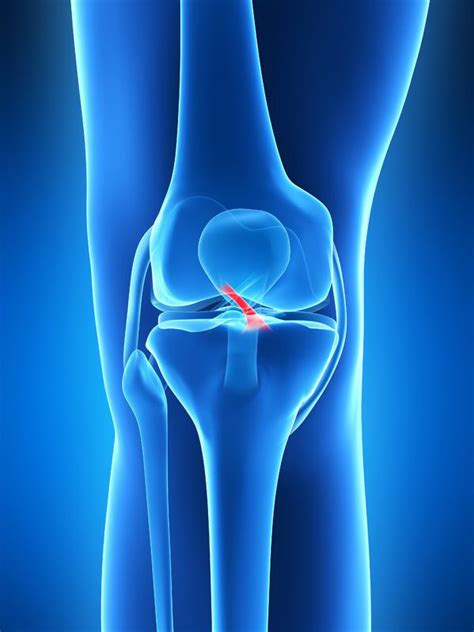 ACL Injury :: South Arkansas Orthopaedics & Sports Medicine