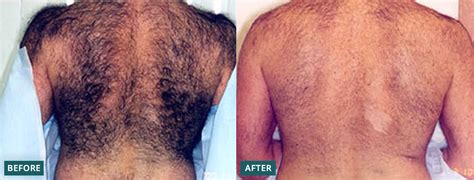 Folliculitis After Laser Hair Removal - Best Hairstyles Ideas for Women and Men in 2023