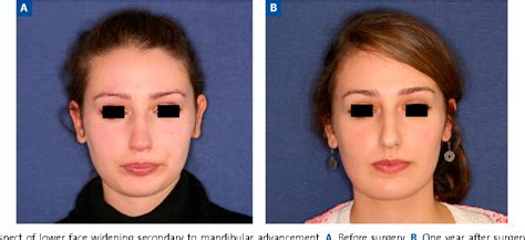 Figure 1 from Posterior mandibular widening secondary to advancement sagittal split osteotomy: A ...