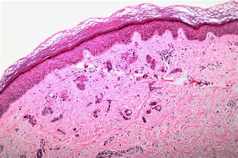 Syringoma Histology