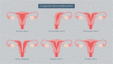 Unicornuate Uterus - Dr Eleftherios Meridis