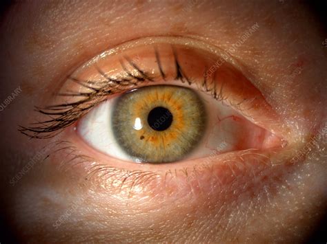 Iris Nevus - Stock Image - C027/2064 - Science Photo Library