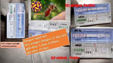 Dengue NS1 antigen positive IgM positive and IgG positive and significances in dengue fever ...