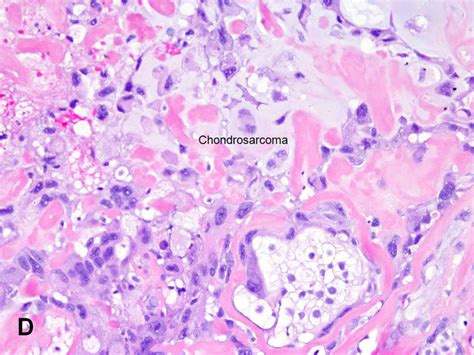 American Urological Association - Sarcomatoid Carcinoma/Carcinosarcoma