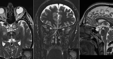 Radiology MRI: Idiopathic Intracranial Hypertension