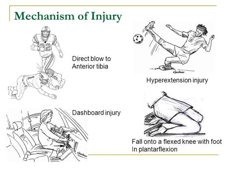 Posterior Cruciate Ligament [PCL] Tear - Sun Orthopaedic