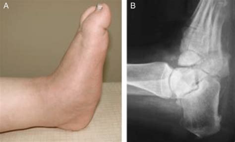 Rocker-bottom Charcot foot (a) Clinical appearance (b) Lateral radiograph. | Download Scientific ...