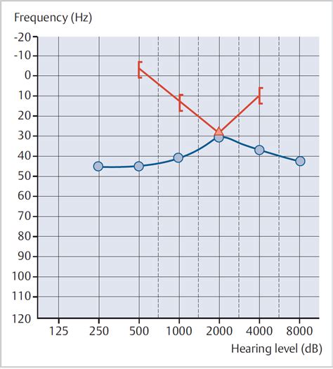 Otosclerosis Audiogram Carhart Notch