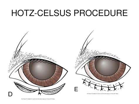 PPT - ONYCHECTOMY PowerPoint Presentation, free download - ID:6652990