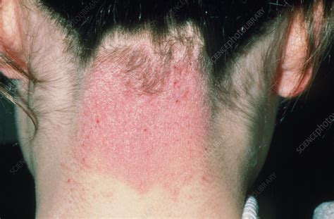 Eczema on the back of the neck in a girl - Stock Image - M150/0111 - Science Photo Library