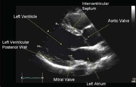 Parasternal Long Axis | Point of Care Ultrasound