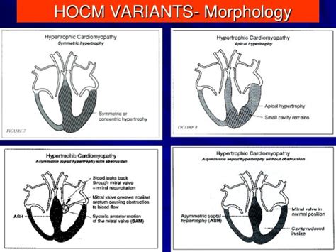 Hocm