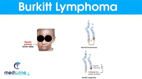 Burkitt's Lymphoma:Causes , Symptoms and Treatment - YouTube