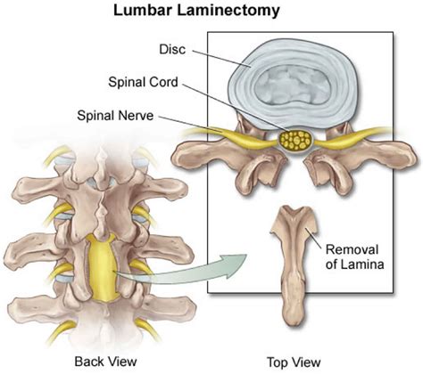 Back surgery, lower back surgery, indications, types, risks & complications